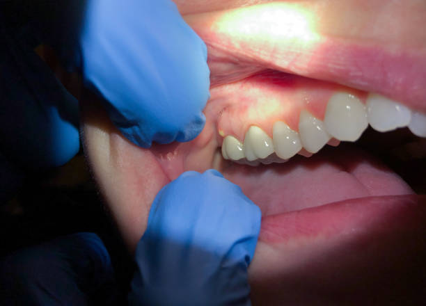 Best Knocked-Out Tooth Emergency  in Tangerine, FL